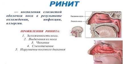 Симптоми та типи алергії на пил: визначення та поради для боротьби