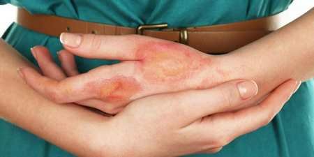 Алергія на пил – симптоми і види захворювань