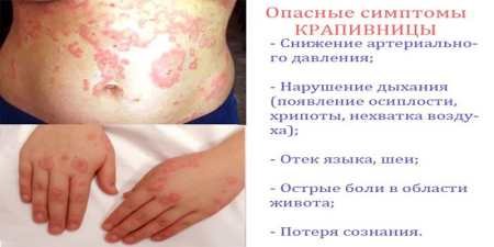 Алергія на пил – симптоми і види захворювань