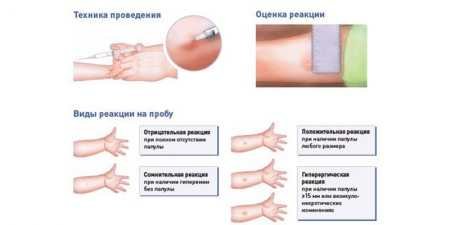 Аналіз крові на туберкульоз: як визначити захворювання