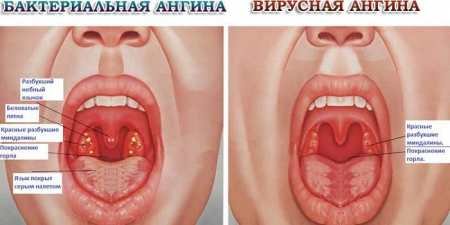 Біль у горлі при ковтанні: причини і лікування