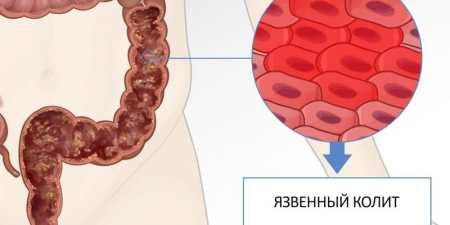 Чи допомагає активоване вугілля при закрепі