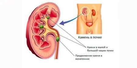 Причини, видалення та розчинення каменів у нирках: дієта для профілактики
