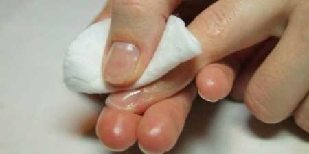 Нітрофунгін від грибка нігтів: застосування