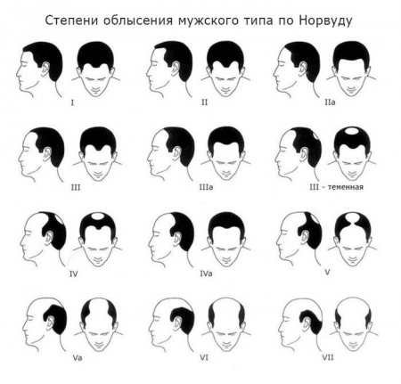 Причини та фактори облисіння у чоловіків: основні аспекти проблеми