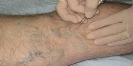 Озонотерапія – показання і протипоказання для крапельниць, уколів і камери