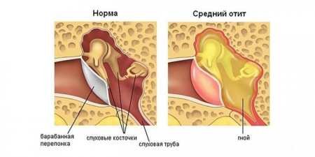 Ефективність знеболюючих засобів при першій допомозі від болю у вусі