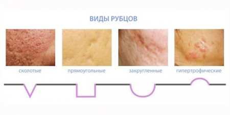 Рубці на обличчі: засоби для видалення і лікування