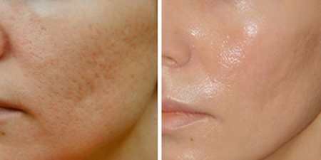 Рубці на обличчі: засоби для видалення і лікування
