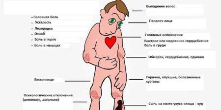 Симптоми бореліозу після укусу кліща у людини — хвороба Лайма