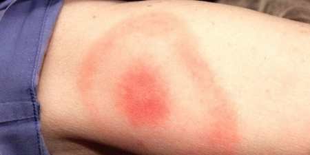 Симптоми бореліозу після укусу кліща у людини — хвороба Лайма