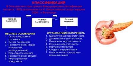 Симптоми та ознаки гострого панкреатиту у дорослих: що важливо знати
