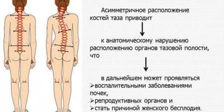 Сколіоз — як виправити вправами, масажем і профілактика