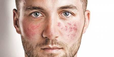 Судинні зірочки на обличчі — лікування апаратними або народними способами