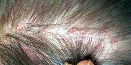 Воші: все, що ви не знали, але соромилися запитати