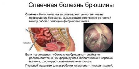 Популярні методики вправ при спайках кишечника: огляд та опис