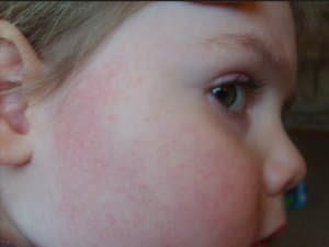 Вживання жимолості, користь і шкода для людського організму