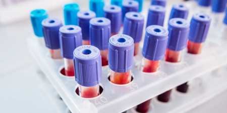 Залізодефіцитна анемія — симптоми і ознаки