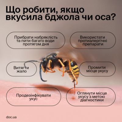 Укус оси: перша допомога, симптоми та як уникнути наслідків Укус оси: перша допомога, симптоми та як уникнути наслідків