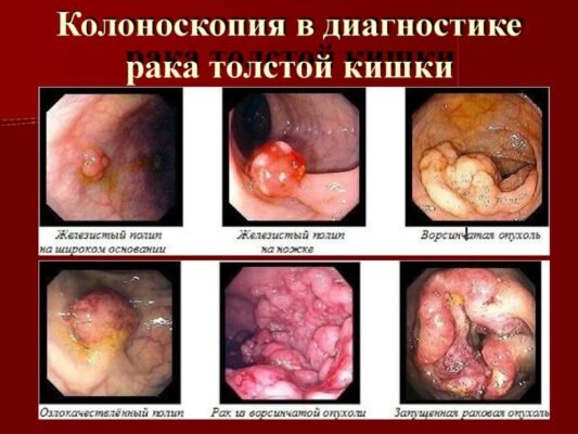 Ректороманоскопія і колоноскопія: у чому різниця між обстеженнями? Ректороманоскопія і колоноскопія: у чому різниця між обстеженнями?