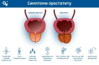 Що не можна їсти при простатиті: заборонені продукти та рекомендації