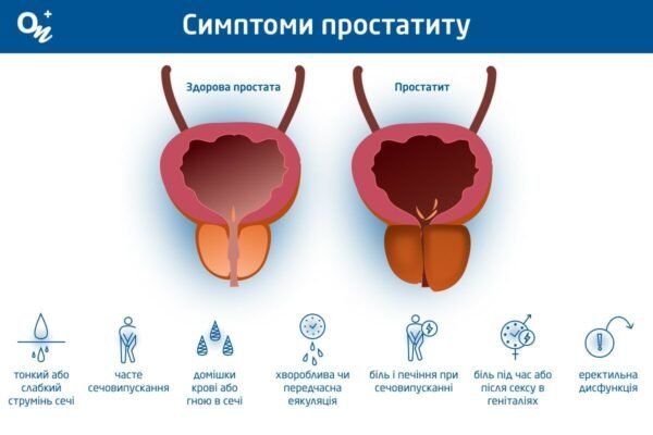 Що не можна їсти при простатиті: заборонені продукти та рекомендації