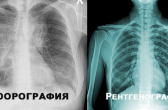 Рентген і флюорографія: основні відмінності та коли кожен метод доречний