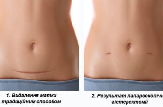 Що можна їсти після операції по видаленню матки: рекомендації дієтологів