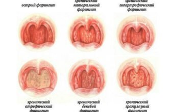 Ларингіт і фарингіт: у чому різниця та як відрізнити захворювання?