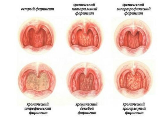 Ларингіт і фарингіт: у чому різниця та як відрізнити захворювання? Ларингіт і фарингіт: у чому різниця та як відрізнити захворювання?