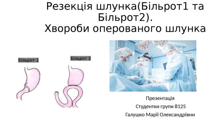 Різниця між процедурами Більрот I і II: що варто знати? Різниця між процедурами Більрот I і II: що варто знати?