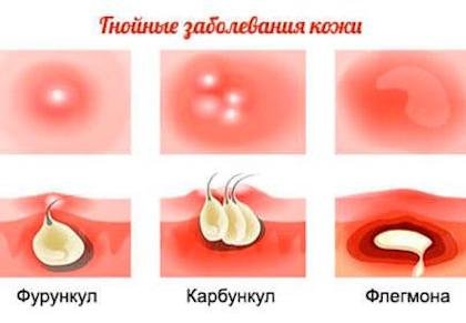 Фурункул і карбункул: у чому різниця та як їх розрізняти?