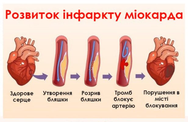 Чи можна їсти мед після інфаркту: користь та ризики для здоров’я Чи можна їсти мед після інфаркту: користь та ризики для здоров’я