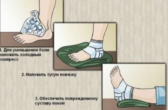 Перша допомога при розтягненні зв’язок: що робити в перші хвилини?