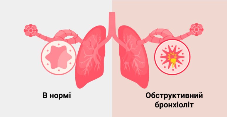 Бронхіт і бронхіоліт: ключові відмінності, симптоми та лікування Бронхіт і бронхіоліт: ключові відмінності, симптоми та лікування