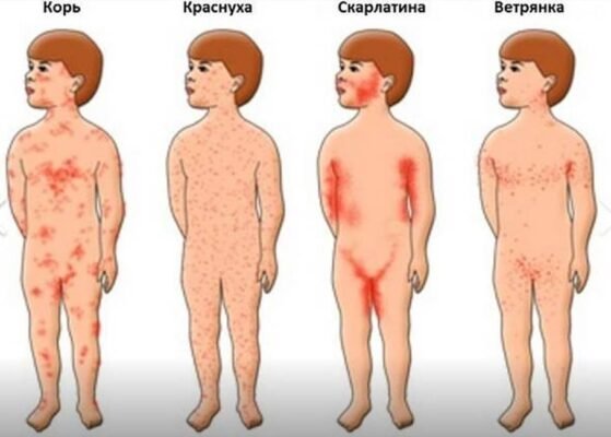 Кір і вітрянка: ключові відмінності та характеристики захворювань Кір і вітрянка: ключові відмінності та характеристики захворювань